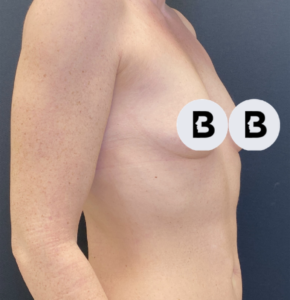 Breast Augmentation Before and After Pictures Buffalo, NY