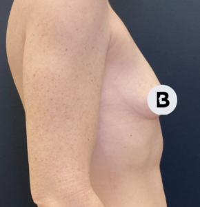Breast Augmentation Before and After Pictures Buffalo, NY