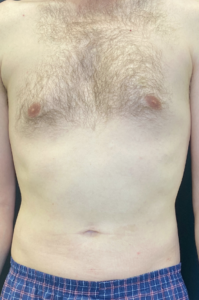 Liposuction Before and After Pictures Buffalo, NY