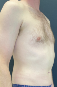 Liposuction Before and After Pictures Buffalo, NY