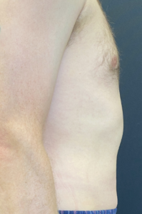 Liposuction Before and After Pictures Buffalo, NY