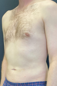 Liposuction Before and After Pictures Buffalo, NY