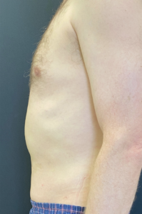 Liposuction Before and After Pictures Buffalo, NY