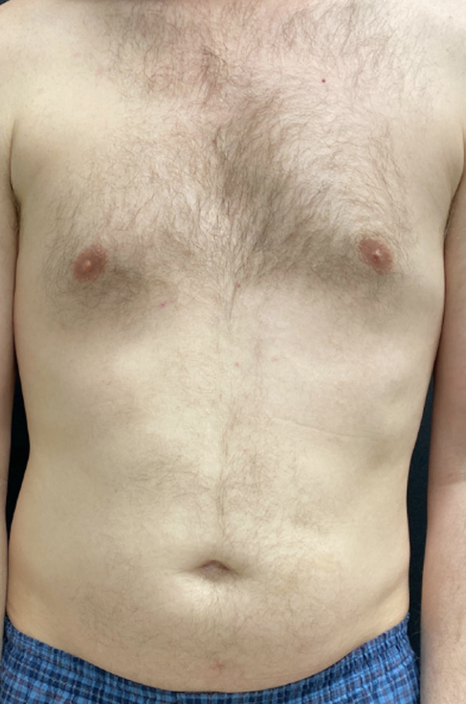 Liposuction Before and After Pictures Buffalo, NY