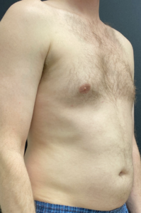 Liposuction Before and After Pictures Buffalo, NY