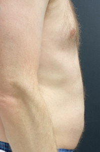 Liposuction Before and After Pictures Buffalo, NY