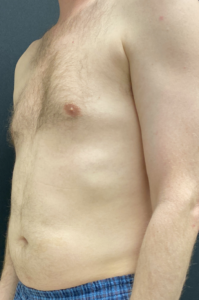 Liposuction Before and After Pictures Buffalo, NY