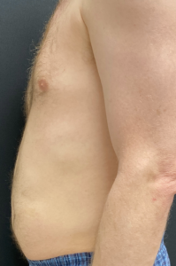 Liposuction Before and After Pictures Buffalo, NY