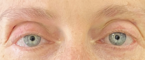 Facial Fillers Before and After Pictures in Buffalo, NY