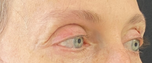 Facial Fillers Before and After Pictures in Buffalo, NY
