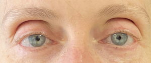 Facial Fillers Before and After Pictures in Buffalo, NY