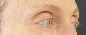 Facial Fillers Before and After Pictures in Buffalo, NY