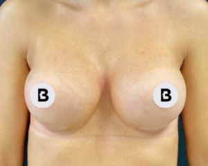 Breast Augmentation Before and After Pictures Buffalo, NY