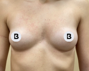Breast Augmentation Before and After Pictures Buffalo, NY