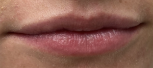 Lip Fillers Before and After Pictures Buffalo, NY