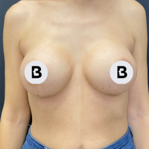 Breast Augmentation Before and After Pictures Buffalo, NY