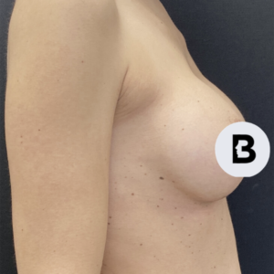 Breast Augmentation Before and After Pictures Buffalo, NY