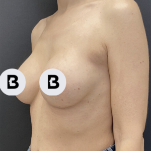 Breast Augmentation Before and After Pictures Buffalo, NY