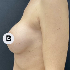 Breast Augmentation Before and After Pictures Buffalo, NY