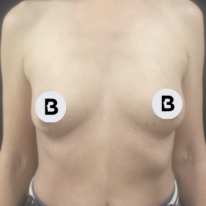 Breast Augmentation Before and After Pictures Buffalo, NY