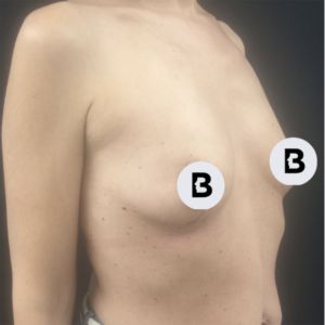 Breast Augmentation Before and After Pictures Buffalo, NY