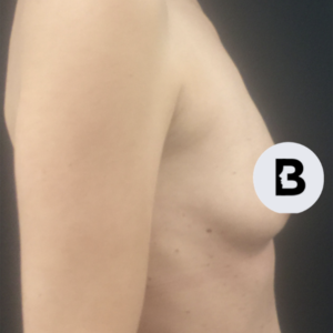 Breast Augmentation Before and After Pictures Buffalo, NY