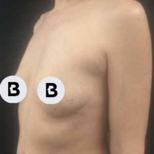 Breast Augmentation Before and After Pictures Buffalo, NY