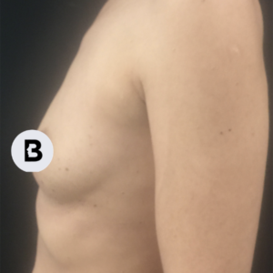 Breast Augmentation Before and After Pictures Buffalo, NY