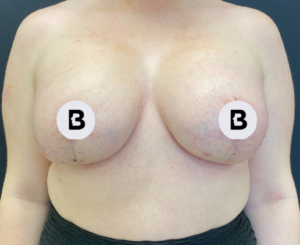 Mastopexy (Breast Lift) Before and After Pictures in Buffalo, NY