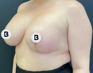 Mastopexy (Breast Lift) Before and After Pictures in Buffalo, NY