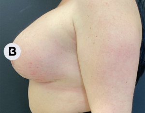 Mastopexy (Breast Lift) Before and After Pictures in Buffalo, NY