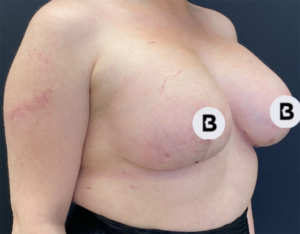 Breast Augmentation Before and After Pictures Buffalo, NY
