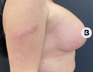 Breast Augmentation Before and After Pictures Buffalo, NY