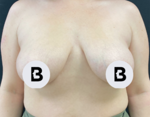Mastopexy (Breast Lift) Before and After Pictures in Buffalo, NY