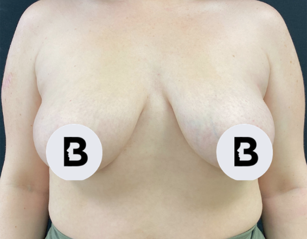 Breast Augmentation Before and After Pictures Buffalo, NY