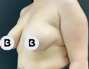Mastopexy (Breast Lift) Before and After Pictures in Buffalo, NY