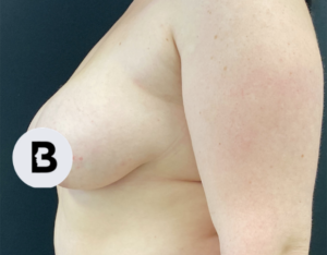Mastopexy (Breast Lift) Before and After Pictures in Buffalo, NY