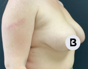 Mastopexy (Breast Lift) Before and After Pictures in Buffalo, NY
