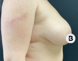 Breast Augmentation Before and After Pictures Buffalo, NY