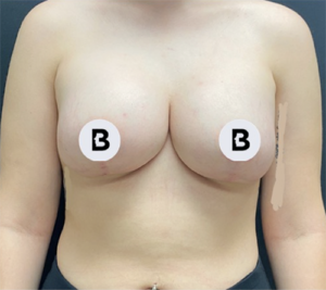 Mastopexy (Breast Lift) Before and After Pictures in Buffalo, NY