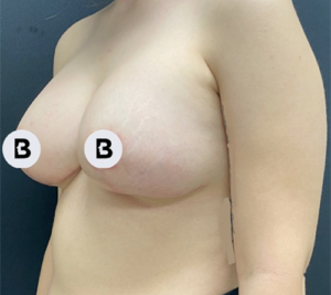 Breast Augmentation Before and After Pictures Buffalo, NY