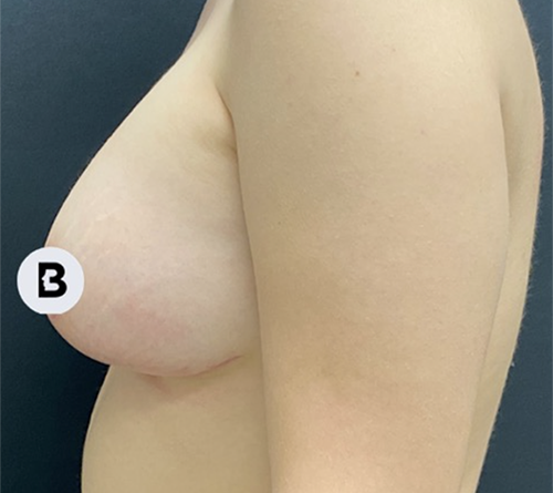 Mastopexy (Breast Lift) Before and After Pictures in Buffalo, NY