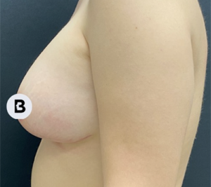 Breast Augmentation Before and After Pictures Buffalo, NY