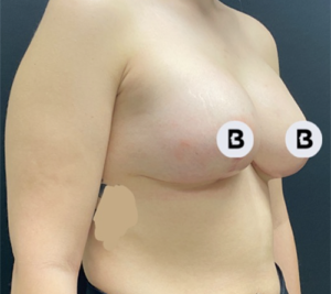 Mastopexy (Breast Lift) Before and After Pictures in Buffalo, NY
