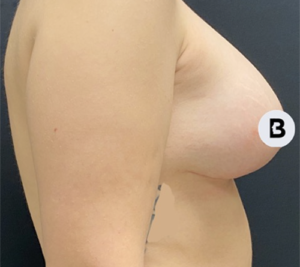 Mastopexy (Breast Lift) Before and After Pictures in Buffalo, NY