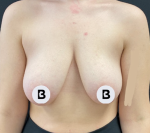 Breast Augmentation Before and After Pictures Buffalo, NY