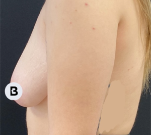 Mastopexy (Breast Lift) Before and After Pictures in Buffalo, NY