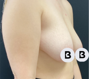 Mastopexy (Breast Lift) Before and After Pictures in Buffalo, NY