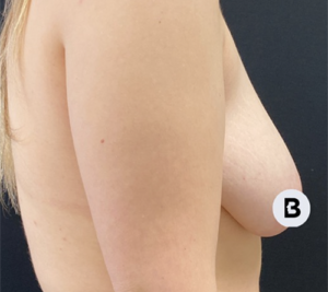 Breast Augmentation Before and After Pictures Buffalo, NY