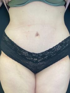 Abdominoplasty (Tummy Tuck) Before and After Pictures Buffalo, NY
